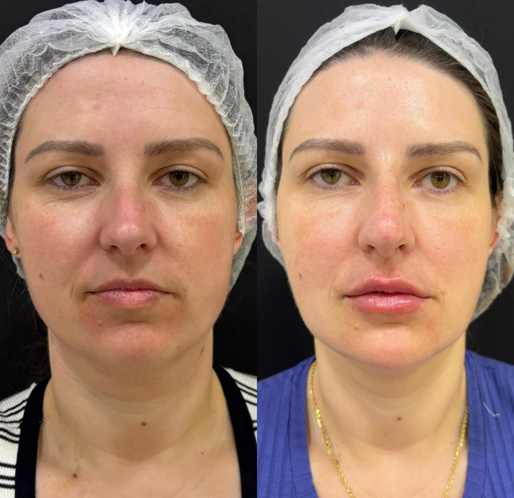 Antes e depois de harmonização facial com resultado natural na Nubelle