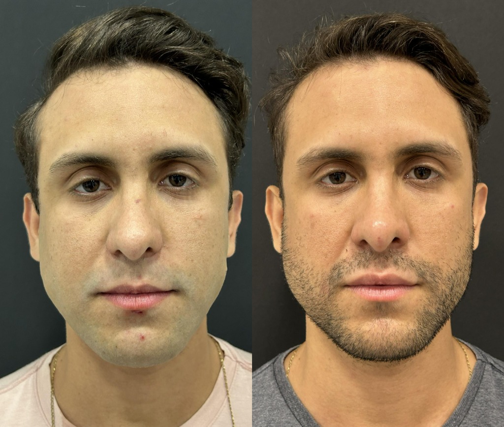 Antes e depois masculino de harmonização facial em vista frontal