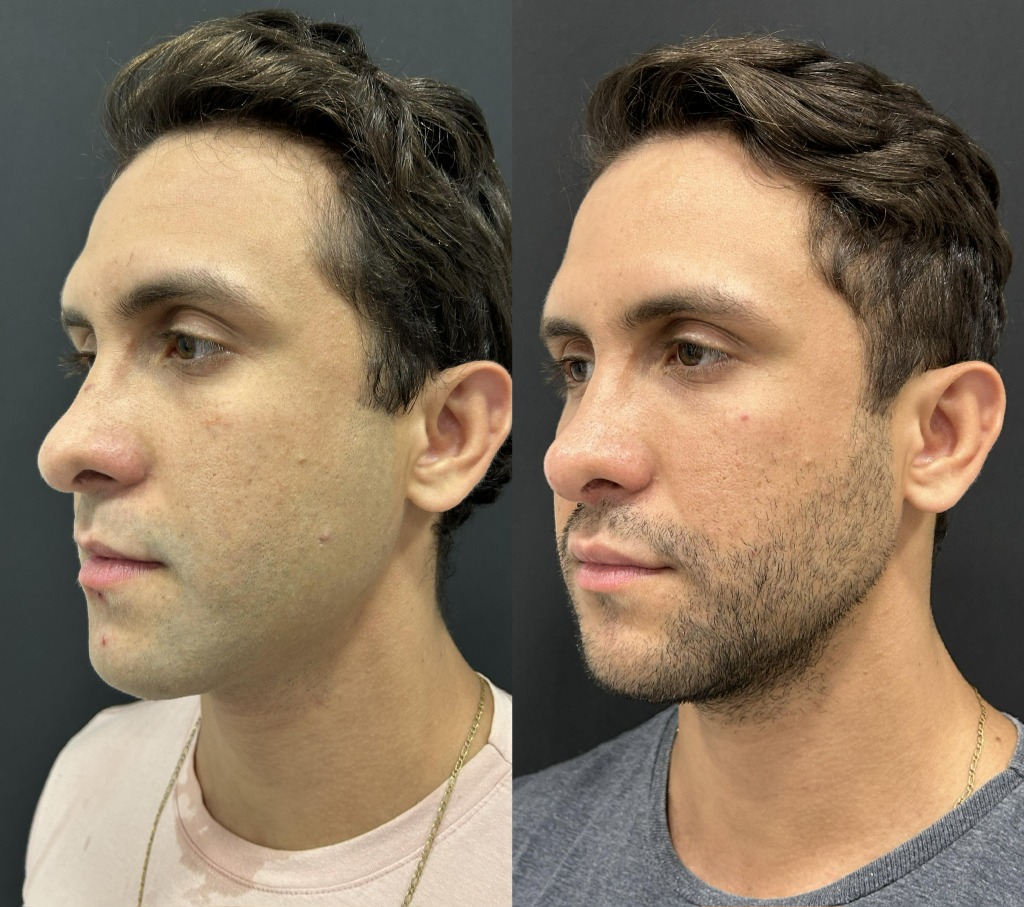Antes e depois masculino de perfil com resultado discreto