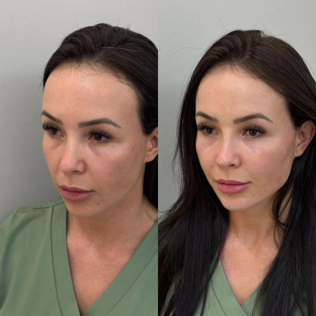Antes e depois feminino de harmonização facial com resultado natural na Nubelle Curitiba