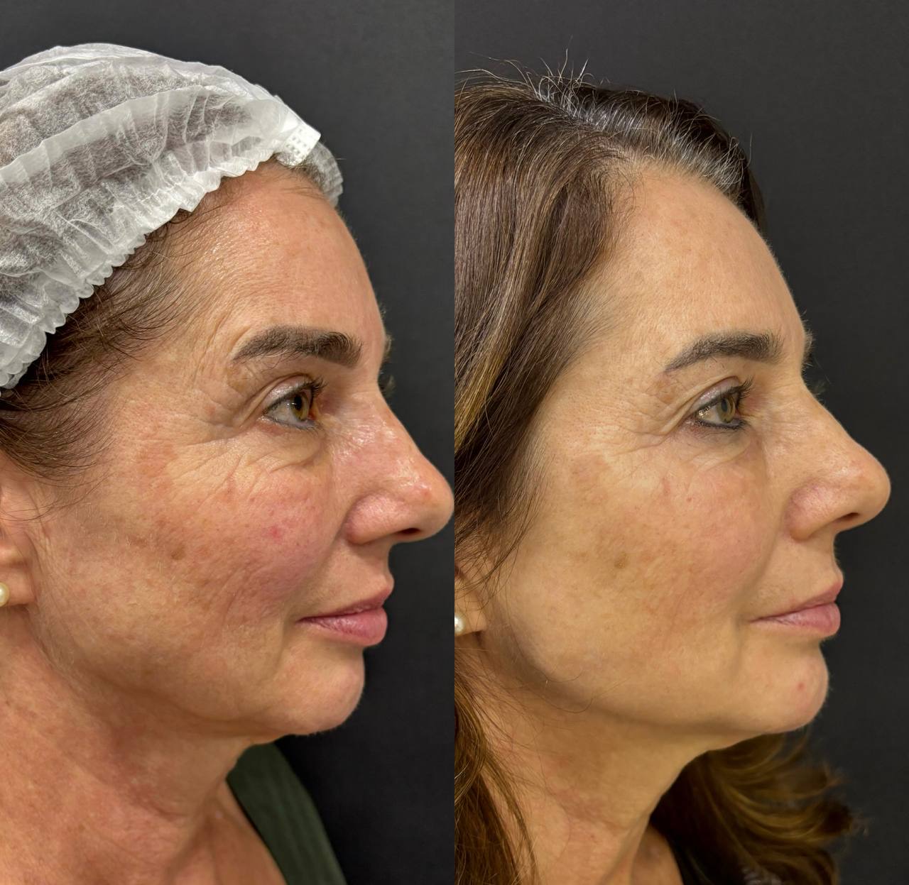 Antes e depois de perfil com melhora de contorno facial