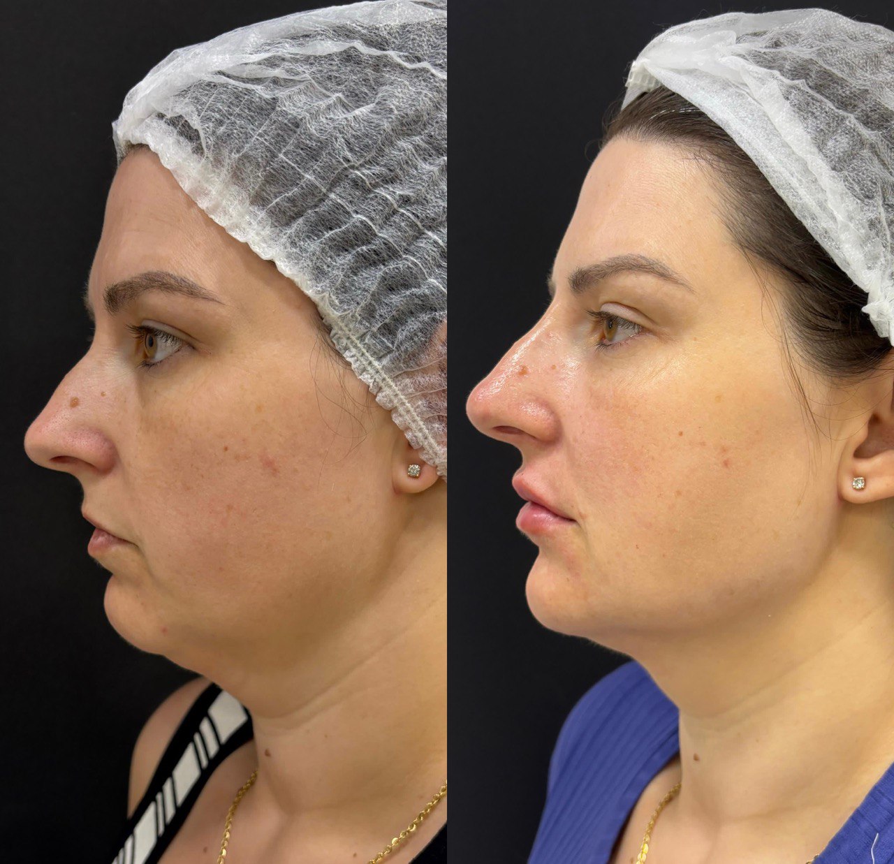 Antes e depois de harmonização facial em perfil feminino