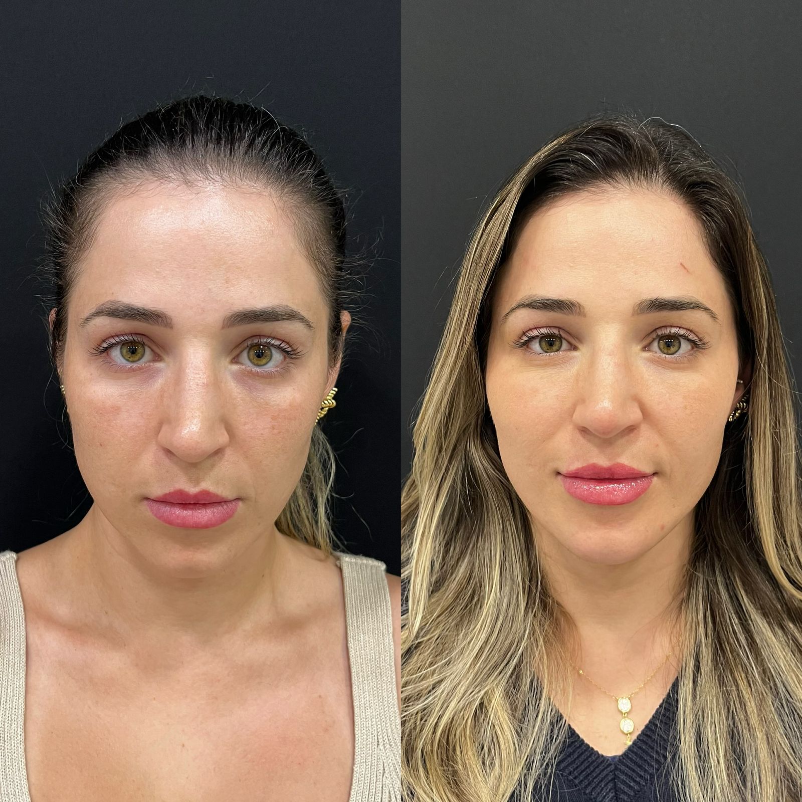 Antes e depois feminino de harmonização facial com melhora de contorno