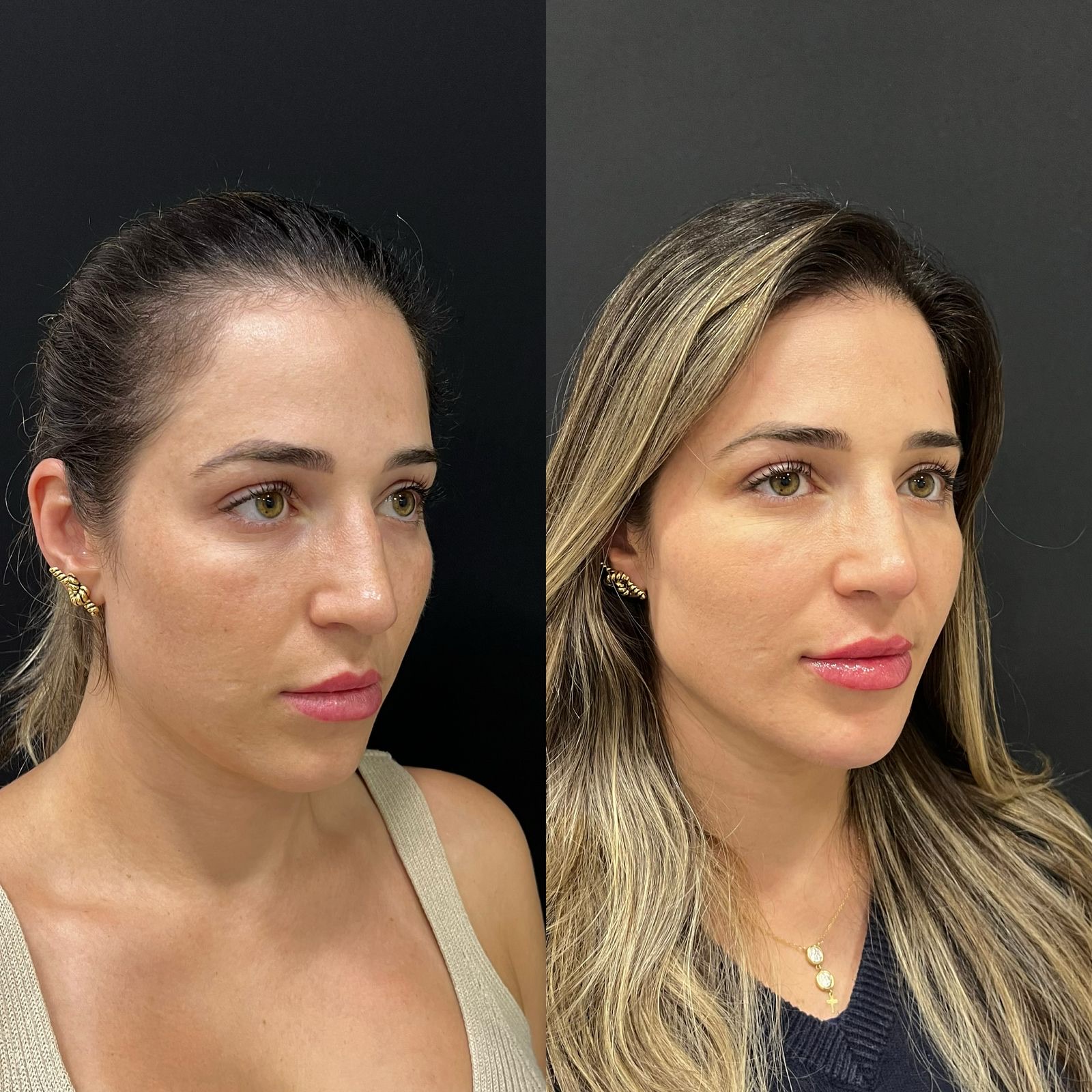 Antes e depois feminino em três quartos com resultado de harmonização facial