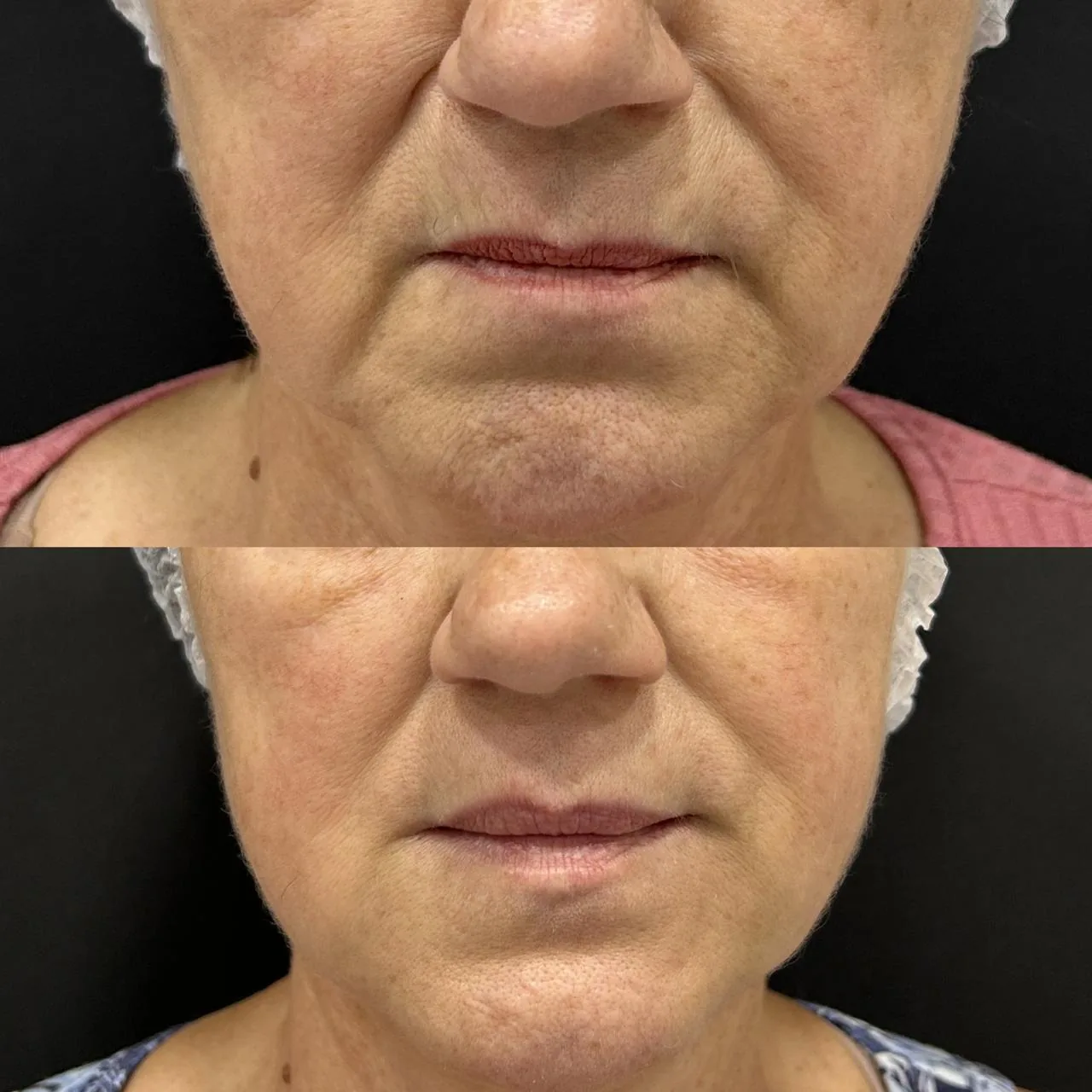 Antes e depois feminino da região perioral e contorno inferior da face na Nubelle Curitiba