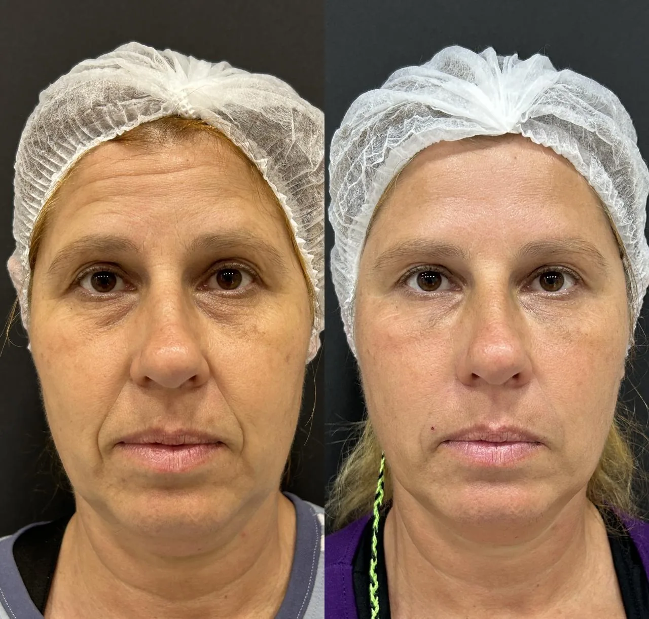 Antes e depois feminino frontal de rejuvenescimento e harmonização facial na Nubelle Curitiba