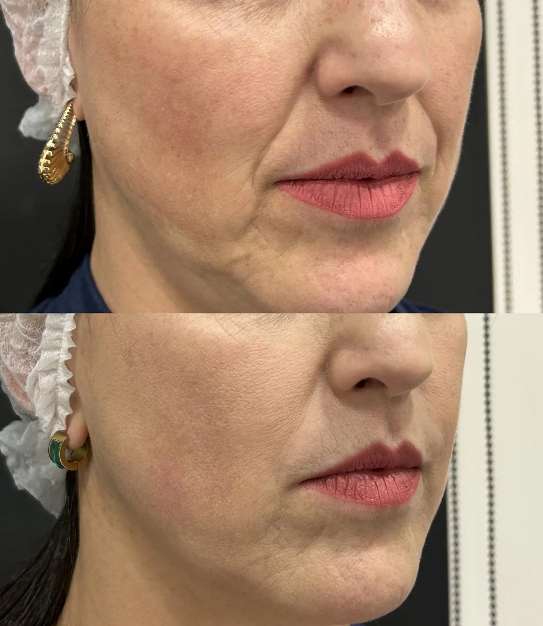 Antes e depois feminino de perfil com melhora do contorno facial na Nubelle Curitiba