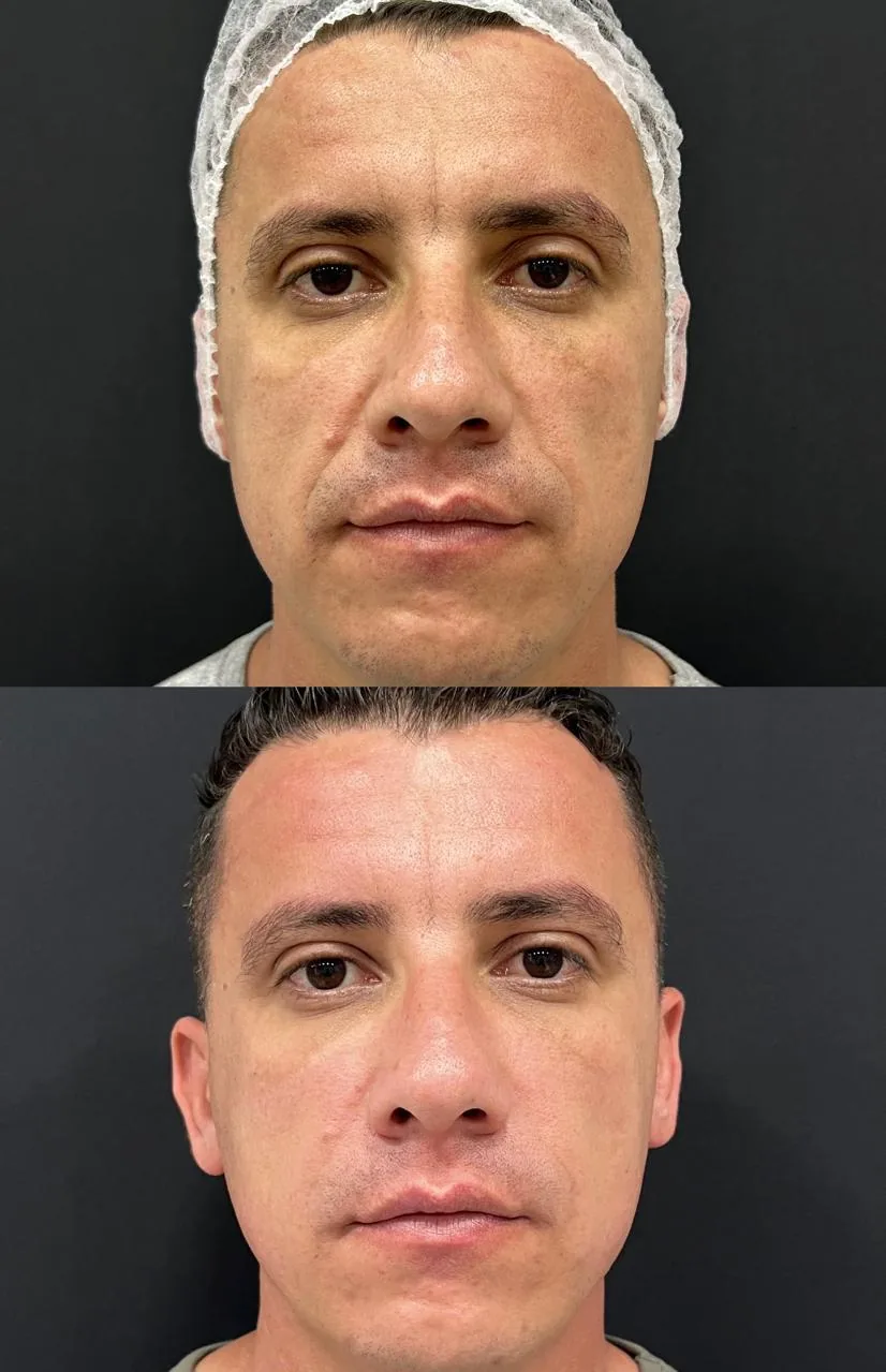 Antes e depois masculino frontal de harmonização facial realizado na Nubelle Curitiba