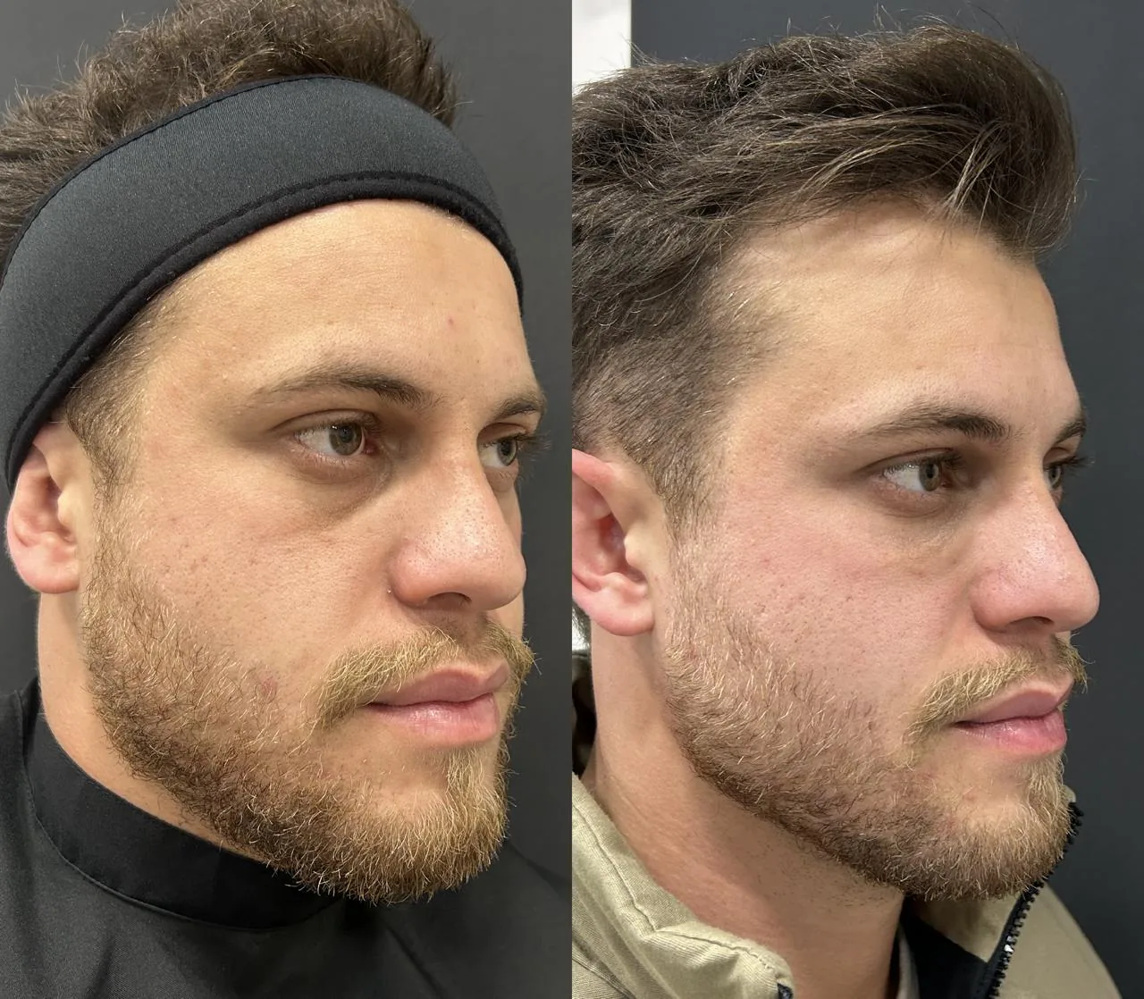 Antes e depois masculino de perfil com harmonização do contorno facial na Nubelle Curitiba