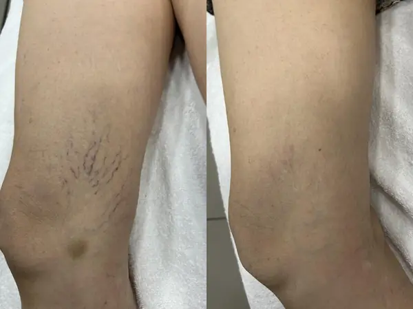 Antes e depois de tratamento de vasinhos acima do joelho com PEIM em paciente da Nubelle Curitiba
