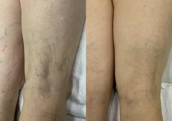 Antes e depois de PEIM em vasinhos na parte de trás do joelho