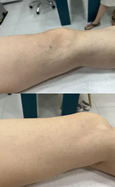 Antes e depois de tratamento de vasinhos no joelho