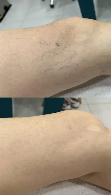 Antes e depois de vasinhos no joelho, vista aproximada