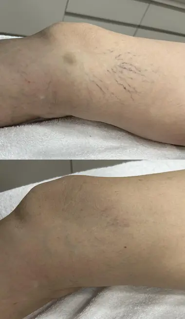 Antes e depois de tratamento de vasinhos na lateral do joelho com PEIM em paciente da Nubelle Curitiba