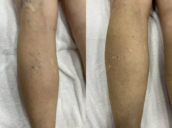 Antes e depois de tratamento de vasinhos na panturrilha