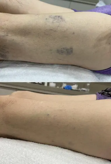 Antes e depois de tratamento de vasinhos na lateral da perna