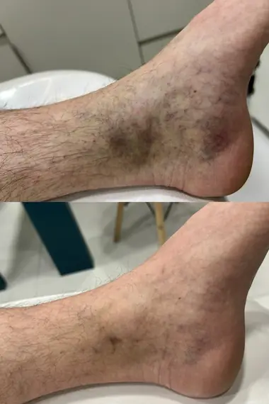 Antes e depois de tratamento de vasinhos no tornozelo em paciente masculino da Nubelle Curitiba