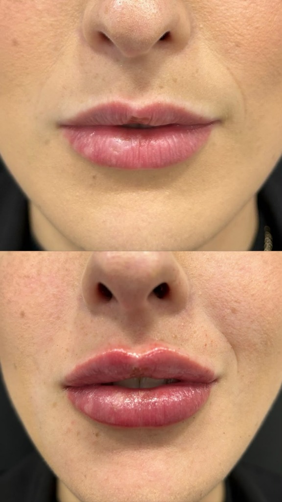 Resultado de preenchimento labial 1