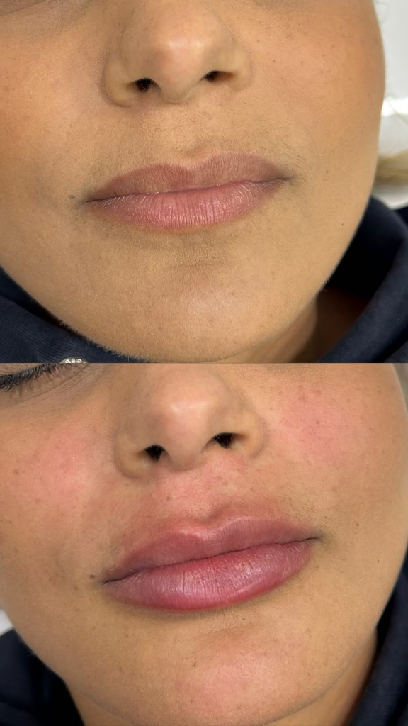 Resultado de preenchimento labial com definicao e naturalidade