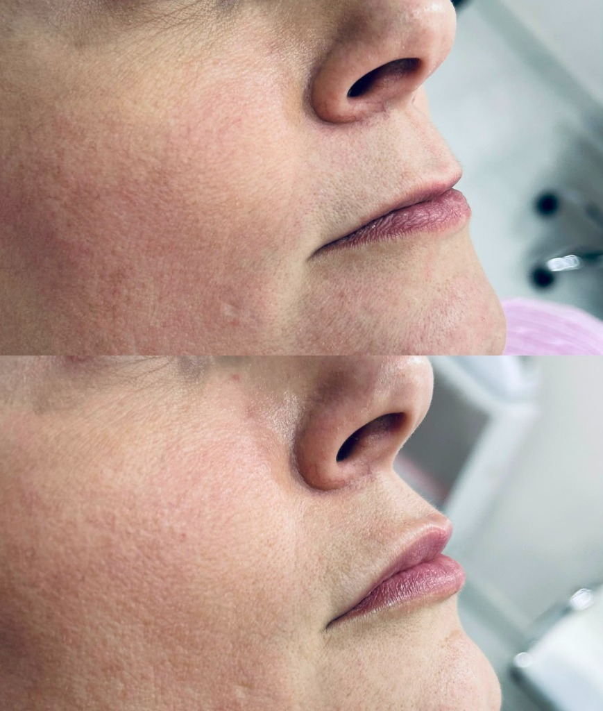 Antes e depois de preenchimento labial na Nubelle Curitiba