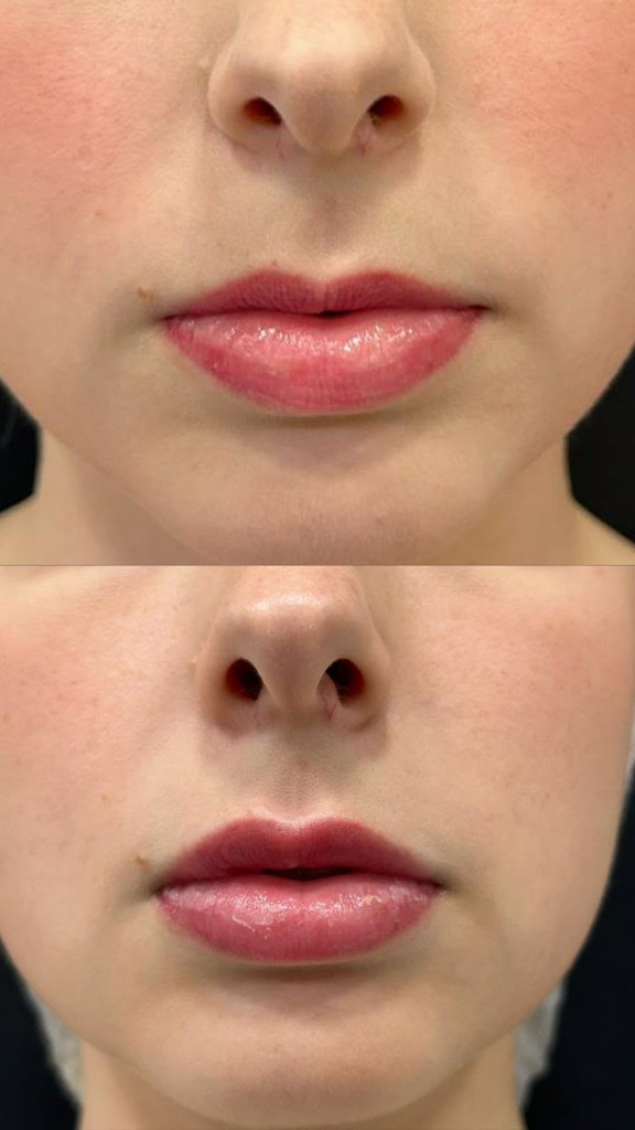 Resultado natural de preenchimento labial na Nubelle Curitiba