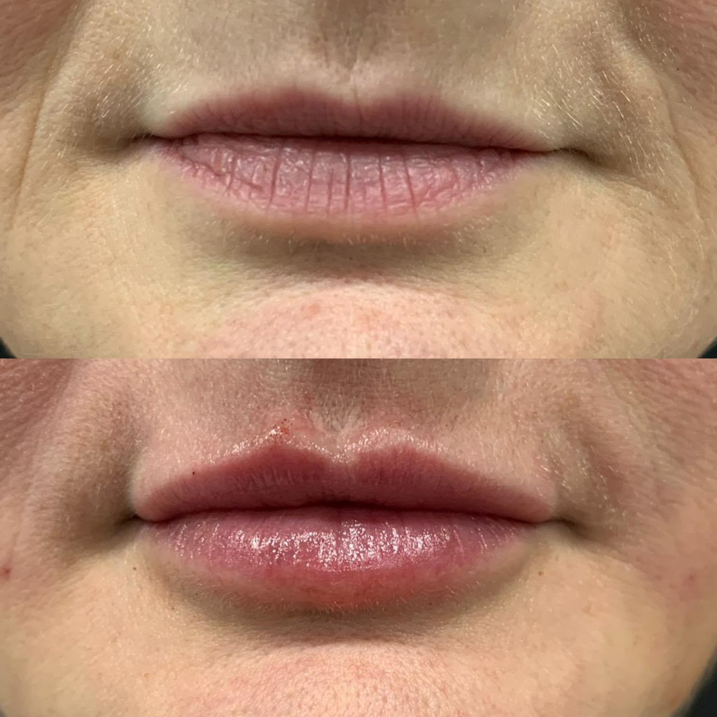 Resultado de preenchimento labial 2
