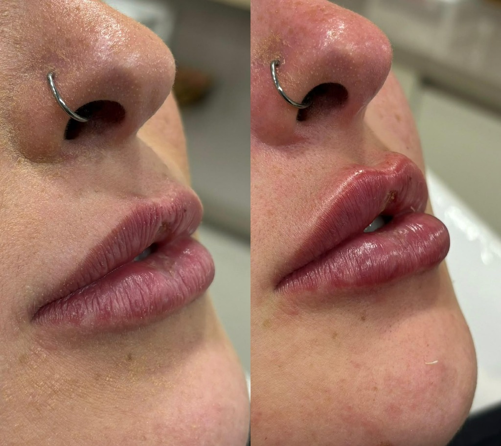 Resultado de preenchimento labial 3