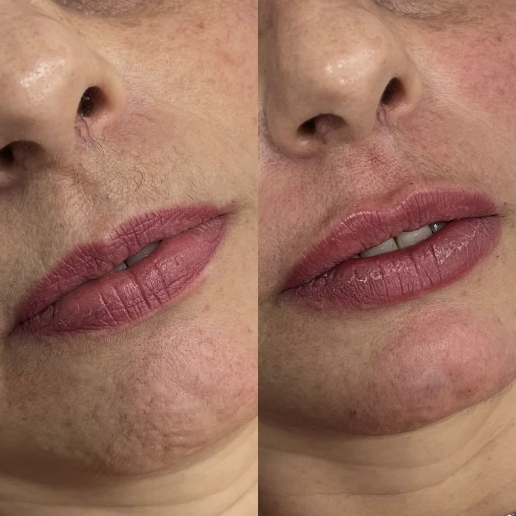 Resultado de preenchimento labial 5