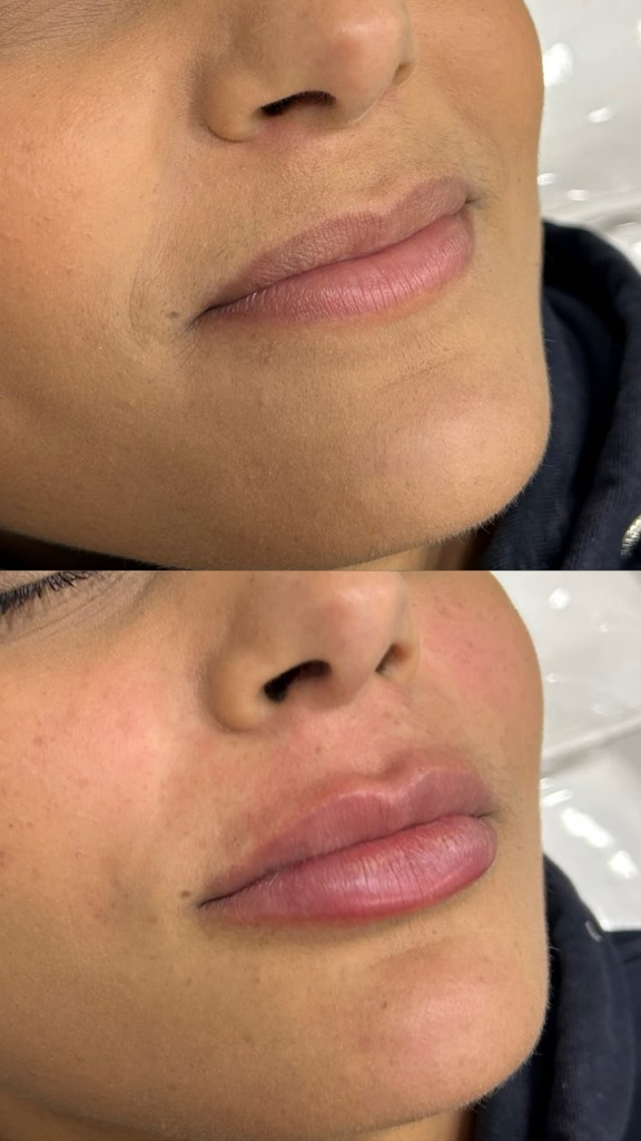 Resultado real de preenchimento labial com resultado natural na Nubelle Curitiba