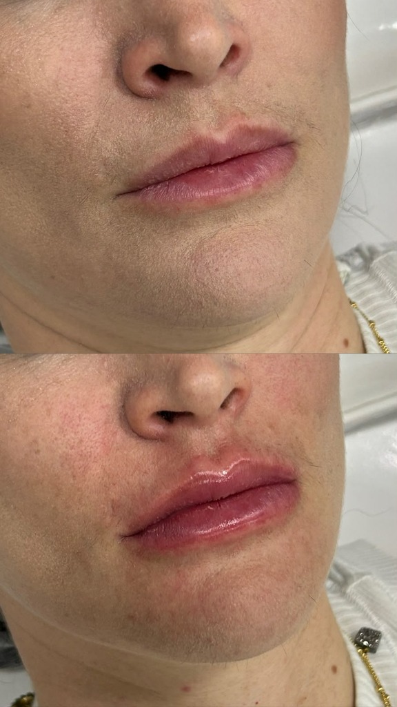 Resultado de preenchimento labial 8