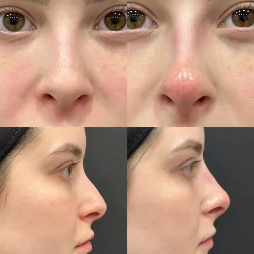 Antes e depois de rinomodelação vista de frente e de perfil