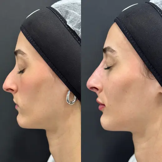 Antes e depois de rinomodelação com preenchimento labial, com ajuste do perfil do nariz e dos lábios em paciente da Nubelle Curitiba