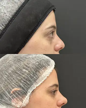 Antes e depois de rinomodelação suavizando o dorso do nariz
