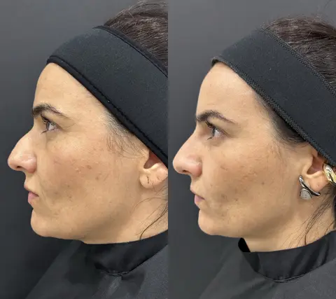 Antes e depois de rinomodelação equilibrando o perfil facial em paciente da Nubelle Curitiba