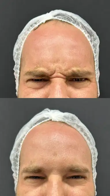 Antes e depois de toxina botulínica na região entre as sobrancelhas em paciente masculino da Nubelle Curitiba