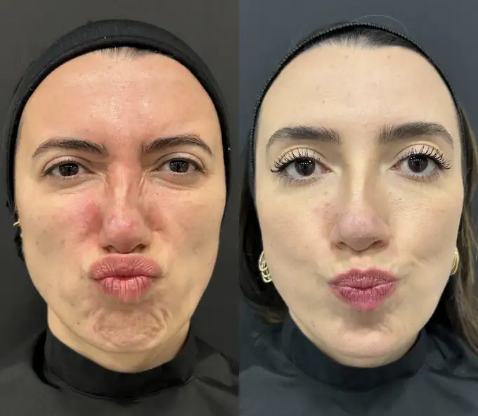 Antes e depois de toxina botulínica nas linhas do nariz e no queixo em paciente feminina