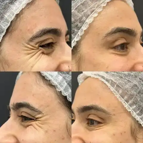 Antes e depois de toxina botulínica nos pés de galinha