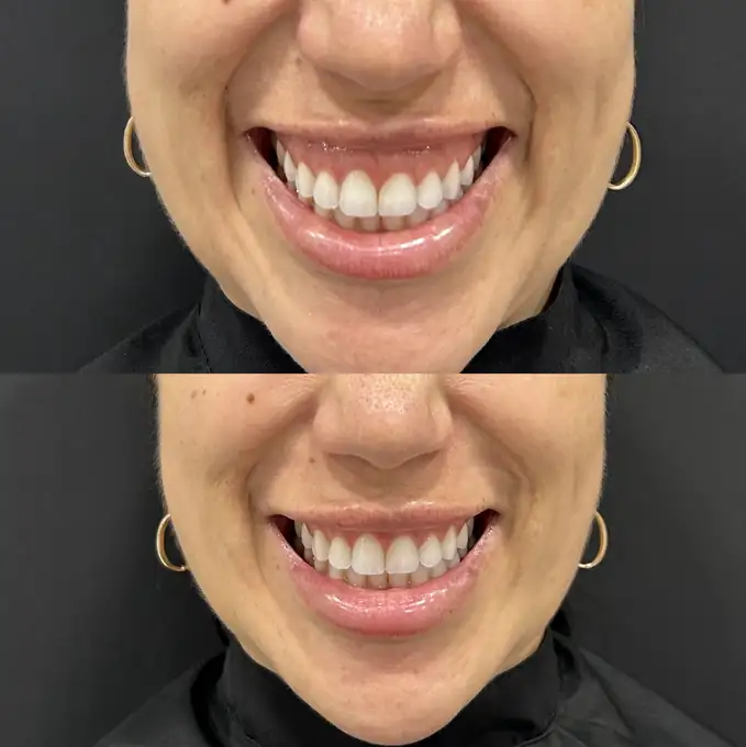 Antes e depois de toxina botulínica para sorriso gengival em paciente da Nubelle Curitiba
