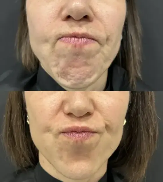 Antes e depois de toxina botulínica no queixo, suavizando o aspecto de casca de laranja