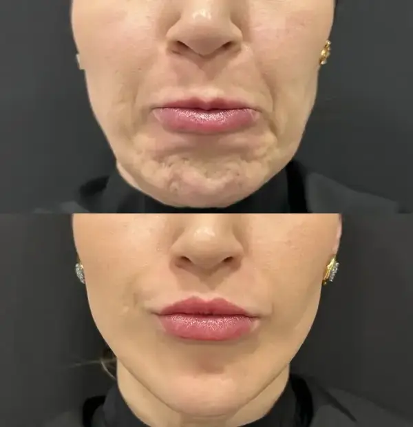 Antes e depois de toxina botulínica no terço inferior da face, suavizando o queixo e melhorando o contorno