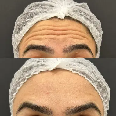 Antes e depois de toxina botulínica nas rugas da testa