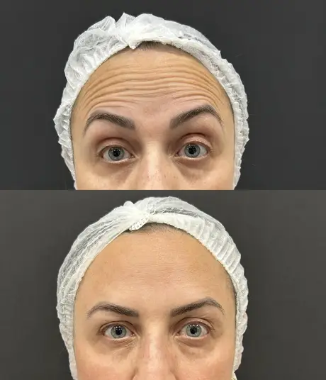 Antes e depois de toxina botulínica suavizando as linhas da testa em paciente feminina