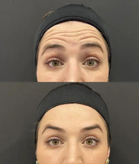 Antes e depois de toxina botulínica nas linhas horizontais da testa