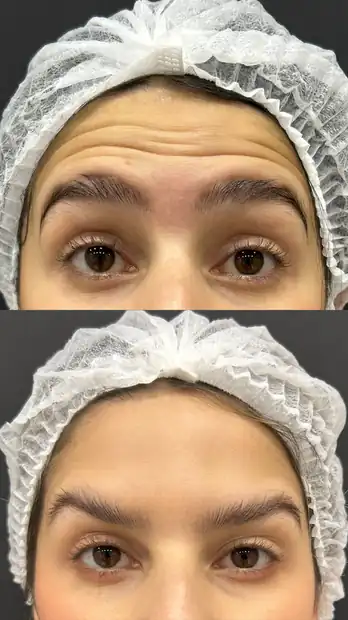 Antes e depois de toxina botulínica na testa em paciente feminina